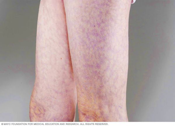 Сетчатое ливедо [18]