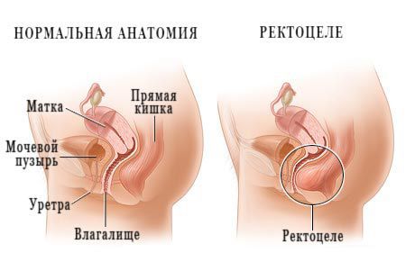 Анатомия органов малого таза в норме и при ректоцеле