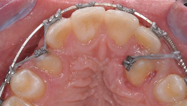 Фиксирование зуба ортодонтической аппаратурой