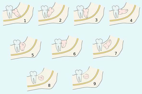 Классификация ретенированных зубов по направлению прорезывания