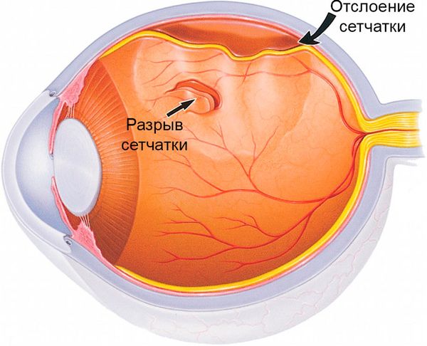Разрыв и отслойка сетчатки