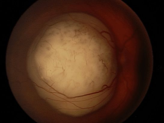 Ретинобластома при осмотре глазного дна [14]