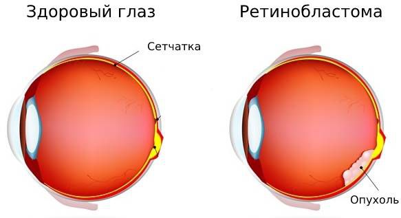 Здоровый глаз и ретинобластома