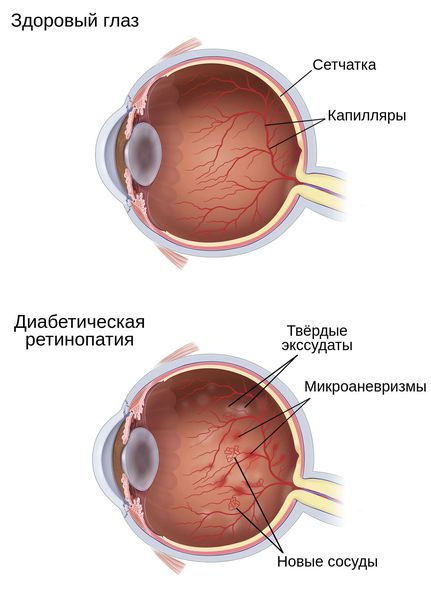 Изменения на сетчатке глаза при диабетической ретинопатии