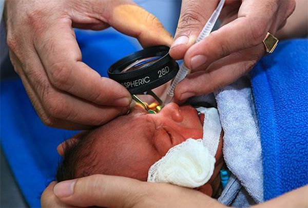 Осмотр глазного дна младенца с помощью лупы [19]