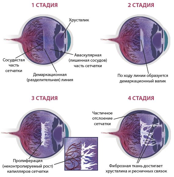 Стадии развития ретинопатии недоношенных