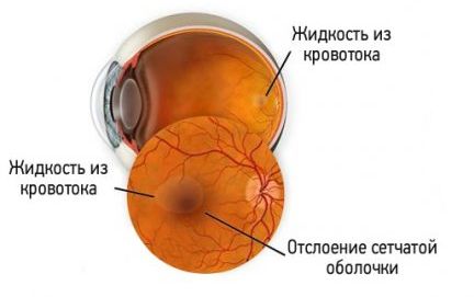 Центральная серозная ретинопатия