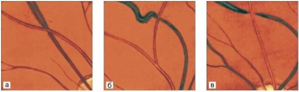 Изменения сосудов сетчатки при артериальной гипертензии. Симптом Салюса — Гунна I (а), II (б) и III (в) степени 