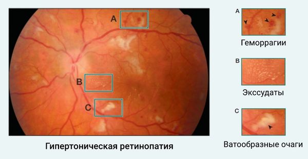 Сетчатка при гипертонической ретинопатии [17]
