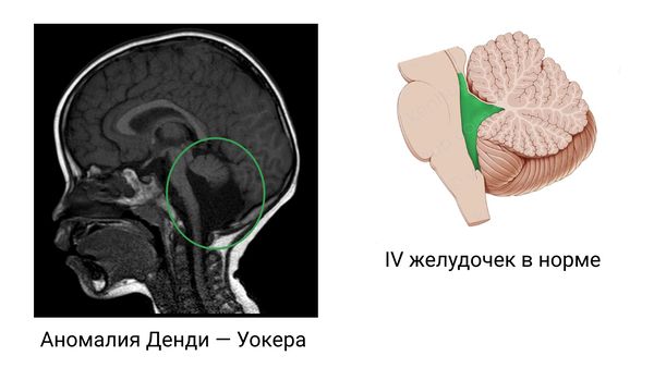 Kисты головного и спинного мозга