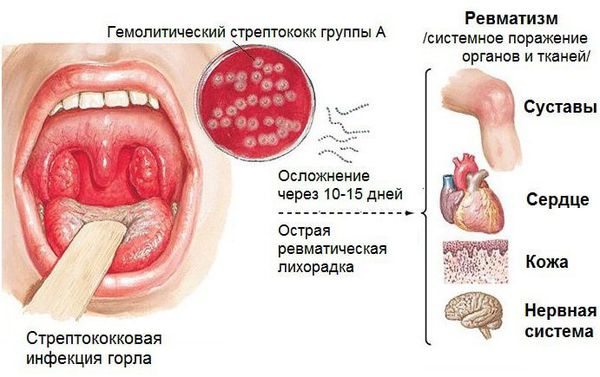Острая ревматическая лихорадка, вызванная бета-гемолитическим стрептококком группы А