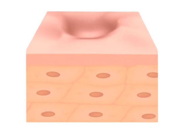 Атрофический рубец