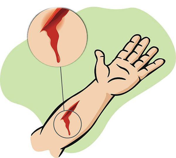 Кровоточивость после ранения