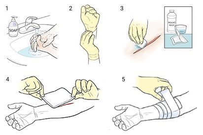 Наложение асептической повязки