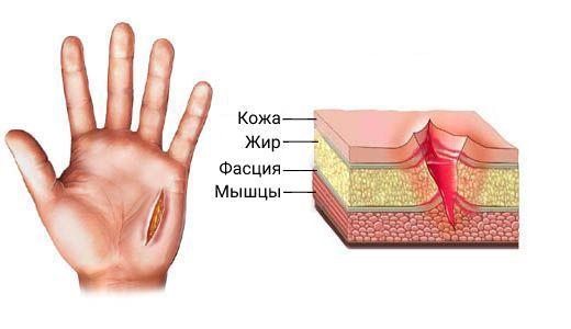 Резаная рана