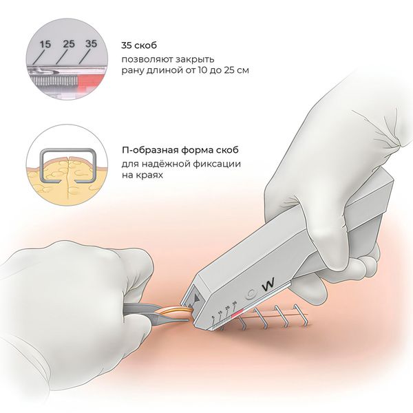 Установка кожных скрепок
