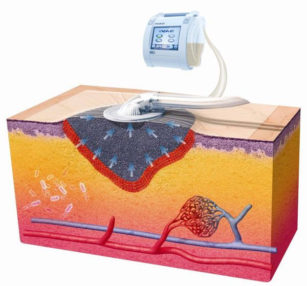 Вакуумное очищение раны