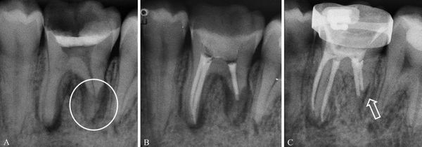 Резорбция корня зуба [33]