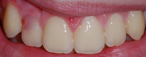 Розовое пятно на зубе [19]
