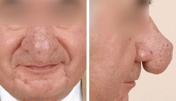 Человек с ринофимой [25]