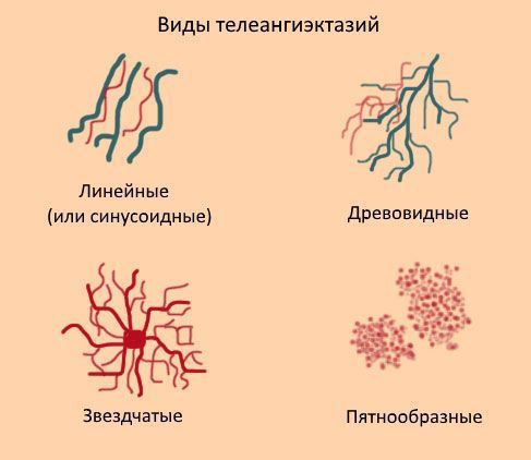 Виды телеангиэктазий (сосудистых звёздочек)