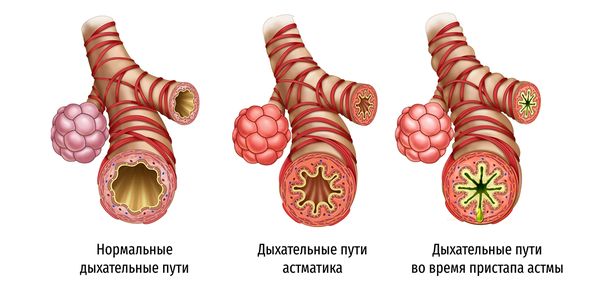 Бронхи в норме и при астме Бронхи в норме и при астме