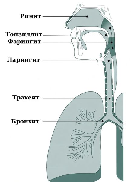 Поражения дыхательного тракта [14]