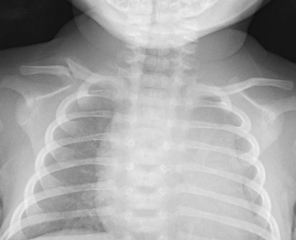Рентгенограмма перелома ключицы, возникшего во время родов