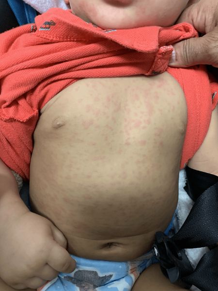 Сыпь при розеоле [12]