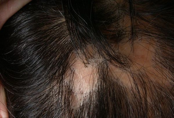 Псевдопелада Брока [23]