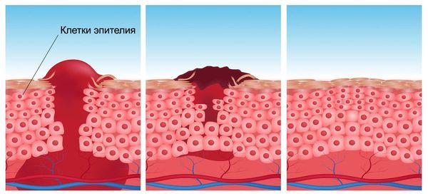 Эпителизация Эпителизация