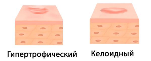 Патологические рубцы
