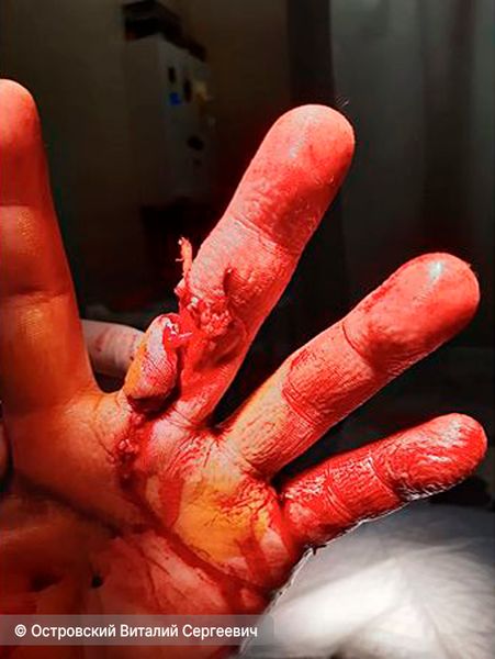 Рваная рана Рваная рана