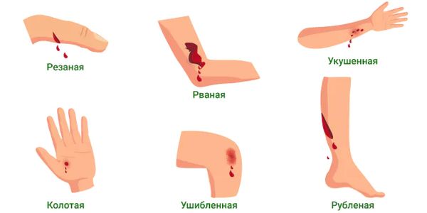 Виды травм