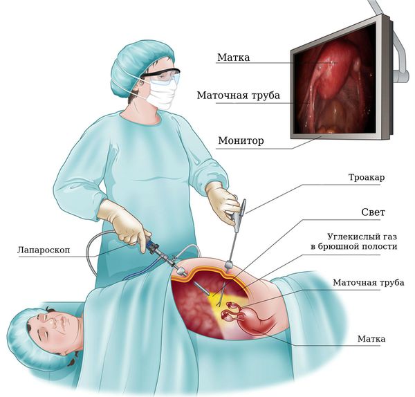 hirurgicheskaya laparoskopiya s