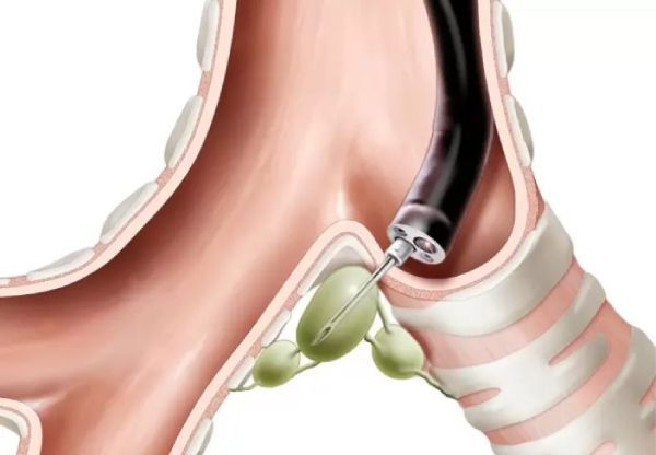 Трансбронхиальная биопсия внутригрудных лимфоузлов