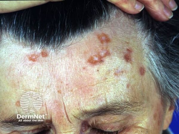 Высыпания при саркоидозе [14]