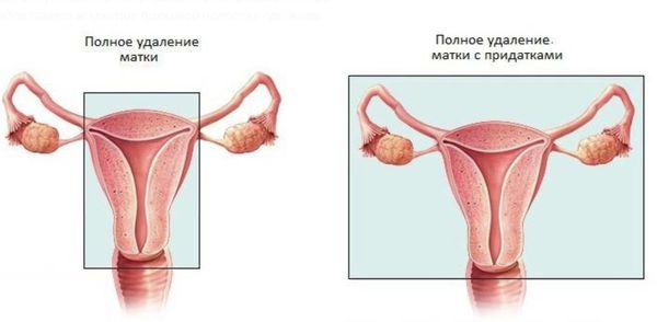 Что такое лейомиосаркома матки. Смотреть фото Что такое лейомиосаркома матки. Смотреть картинку Что такое лейомиосаркома матки. Картинка про Что такое лейомиосаркома матки. Фото Что такое лейомиосаркома матки