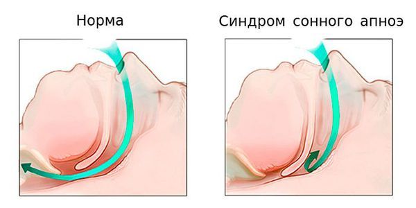 Нормальное поступление воздуха и синдром сонного апноэ