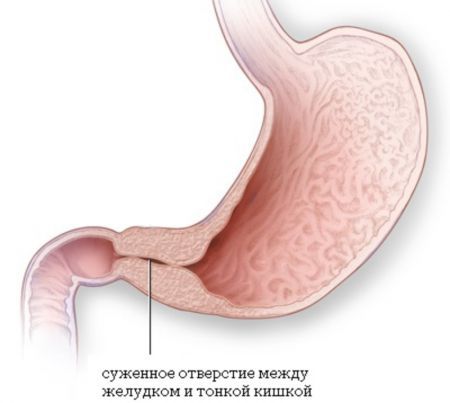 Желудочно-кишечные стриктуры
