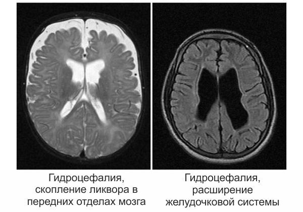 МРТ головного мозга при гидроцефалии