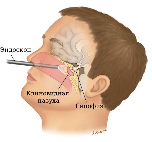 Эндоскопический доступ к клиновидной пазухе [22]
