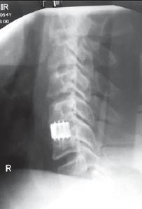 Рентген-снимок позвоночника после дискэктомии. С5–С6 сегменты фиксированы титановым имплантом [12]