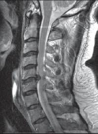 Снимок МРТ шейного отдела позвоночника. Грыжа межпозвонкового диска С5–С6 [12]