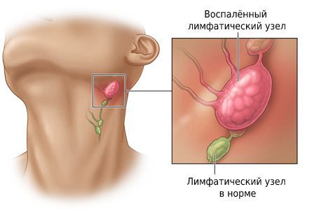 У ребенка под ухом воспалился лимфоузел что делать