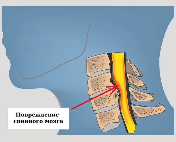 Сдавление спинного мозга Сдавление спинного мозга