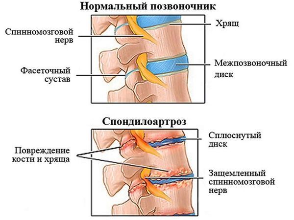 Спондилоартроз Спондилоартроз