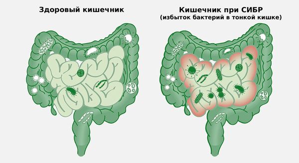Кишечник в норме и при СИБР