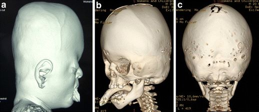 Компьютерная томография черепа с 3D-реконструкцией при синдроме Апера [15]