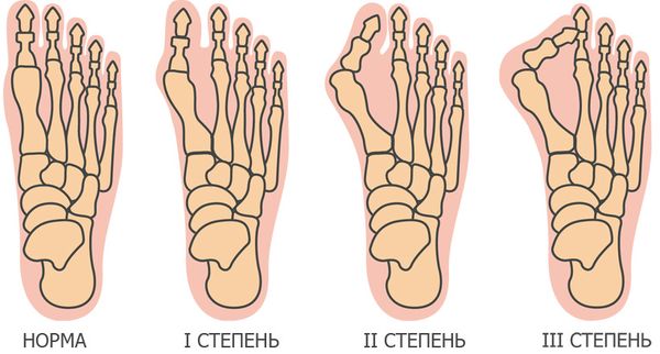 Вальгусная деформация стопы